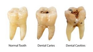 Model showing stages of tooth decay
